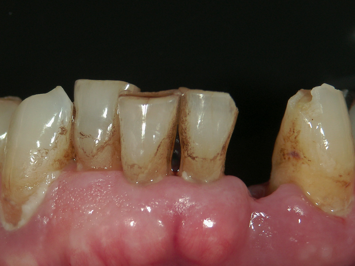 欠損歯列症例　CASE 04