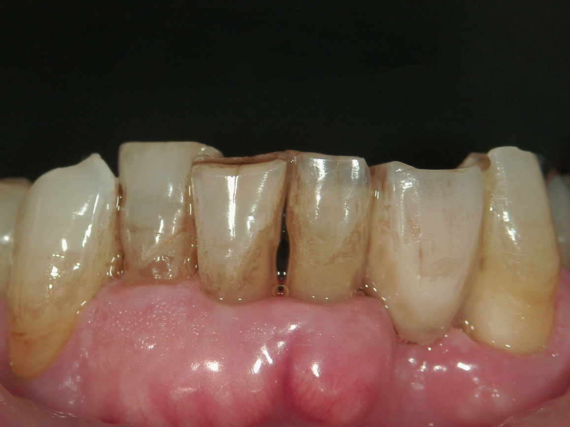 欠損歯列症例　CASE 04