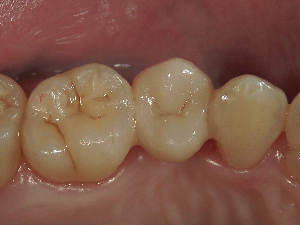 欠損歯列症例　CASE 05