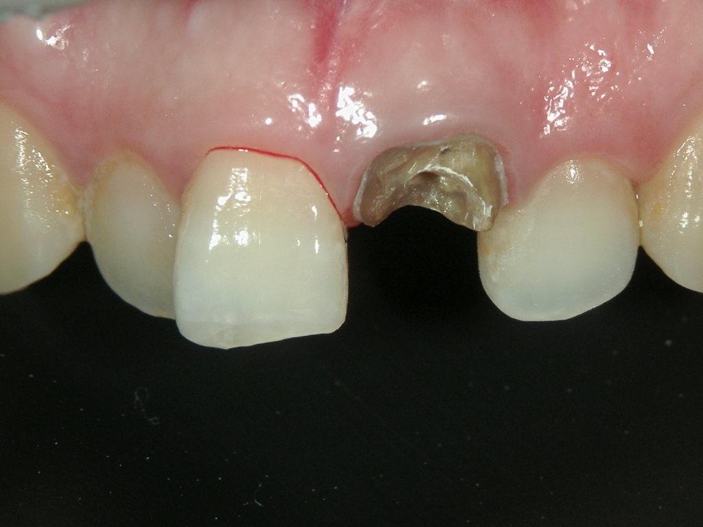 歯冠回復症例　CASE 01